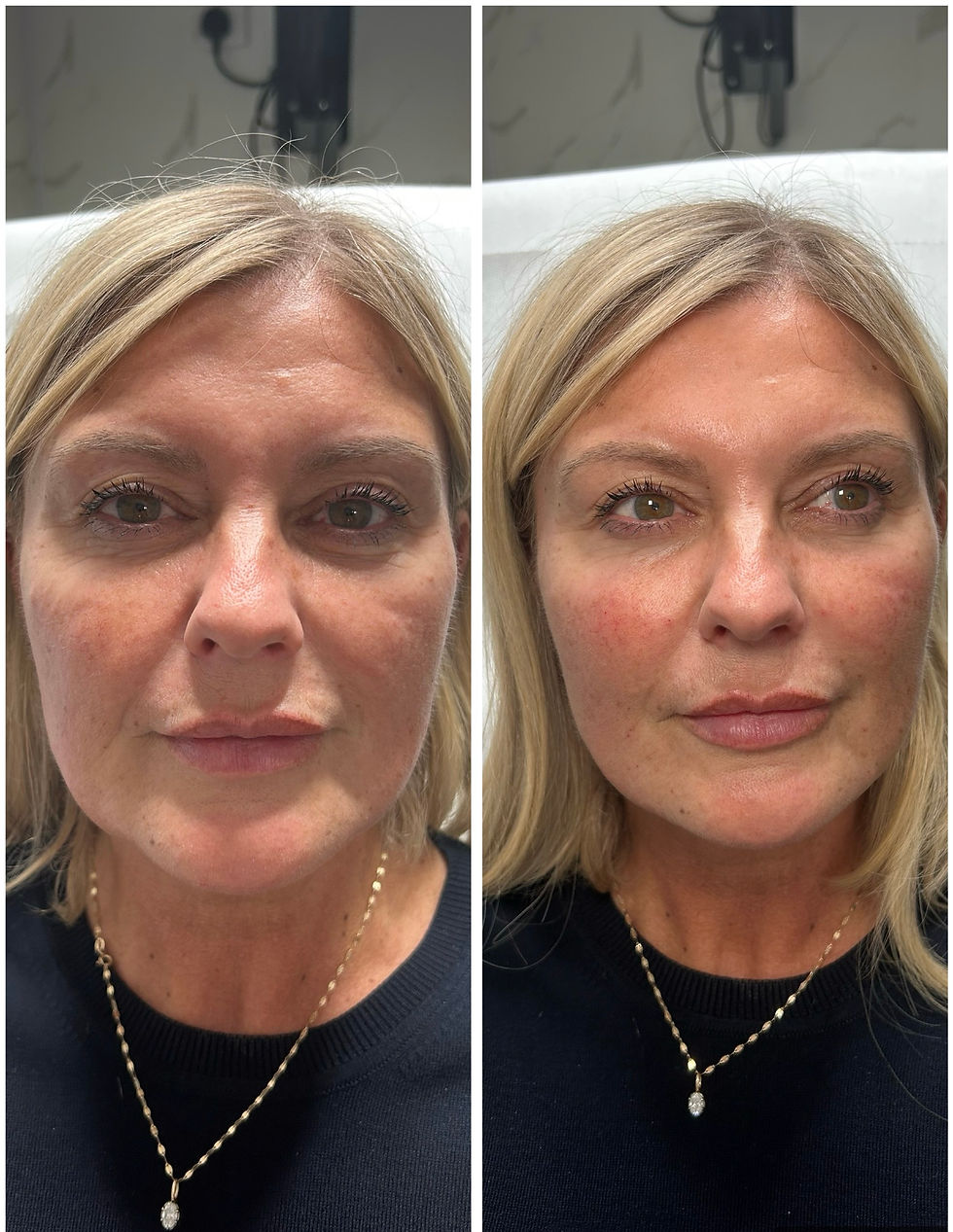 Before and after dermal filler transformation showing smoother skin.
