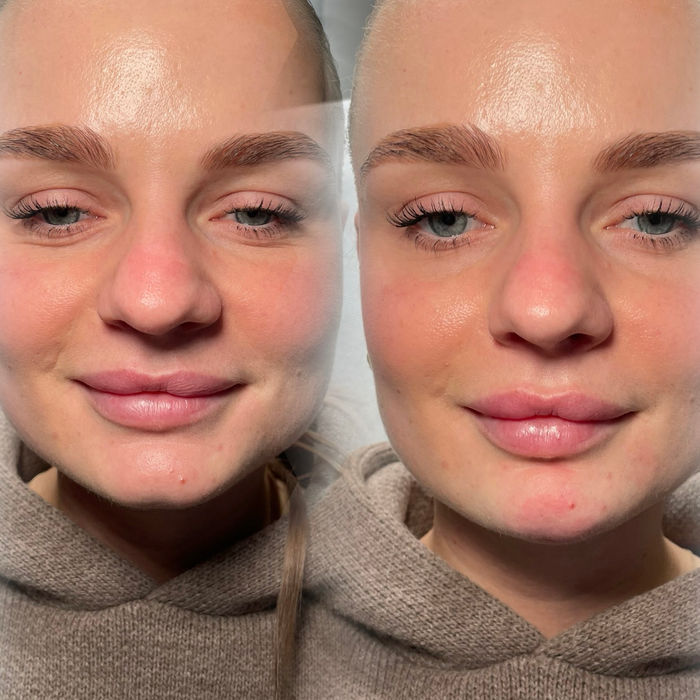Before and after results following dermal filler treatment at Flawless Aesthetics by Tina