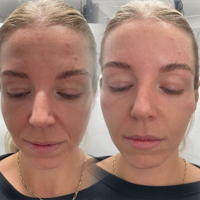 Before and after results following dermal filler treatment to the nasolabial folds at Flawless Aesthetics by Tina