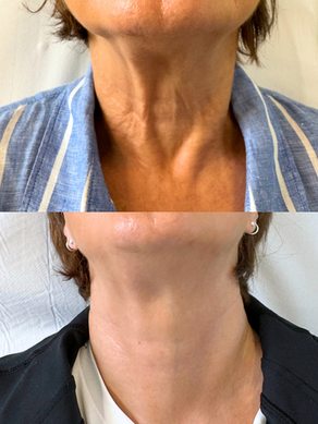 skin boosters neck
