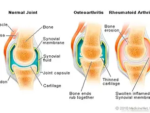 Diagram compares normal joint, osteoarthritis, and rheumatoid arthritis. Labels show bone, synovial fluid, and membrane differences.