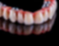 Implant denture