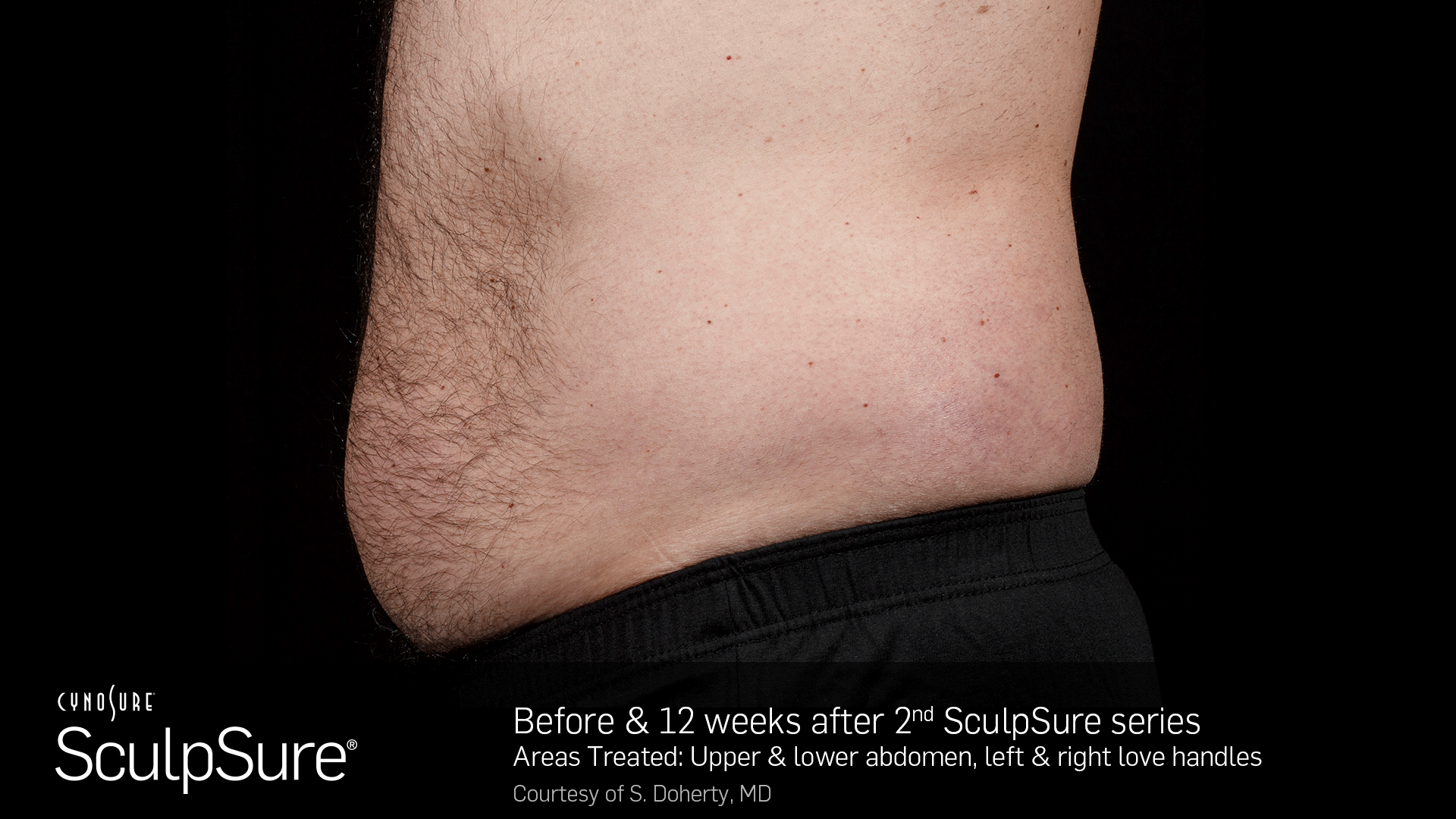SculpSureBA_Animated_Male10