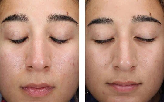 Thumbnail: AlphaRet Clearing Serum 50 ml