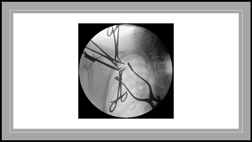 Fluoroscopy of clavicle fixation