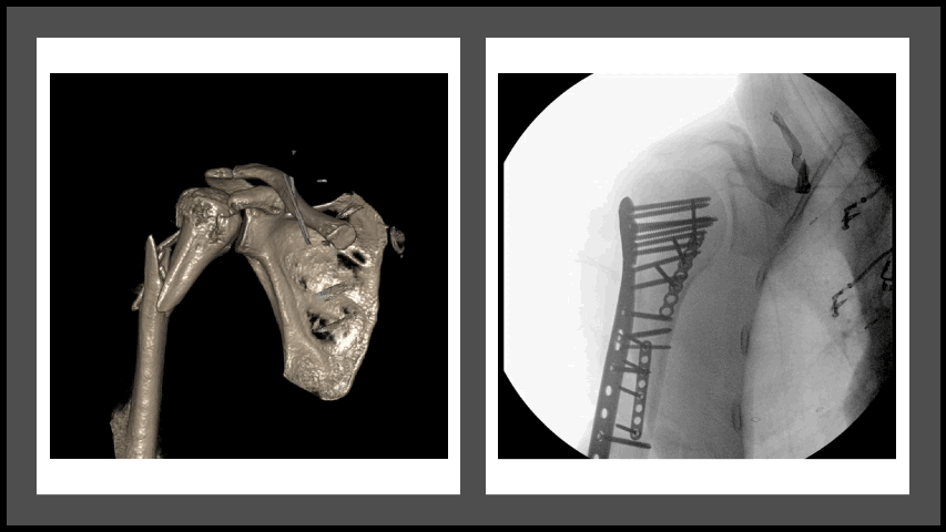 Proximal humerus fracture
