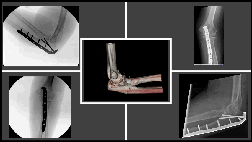 Olecranon fracture