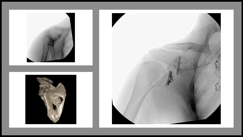 Glenoid and scapula fracture