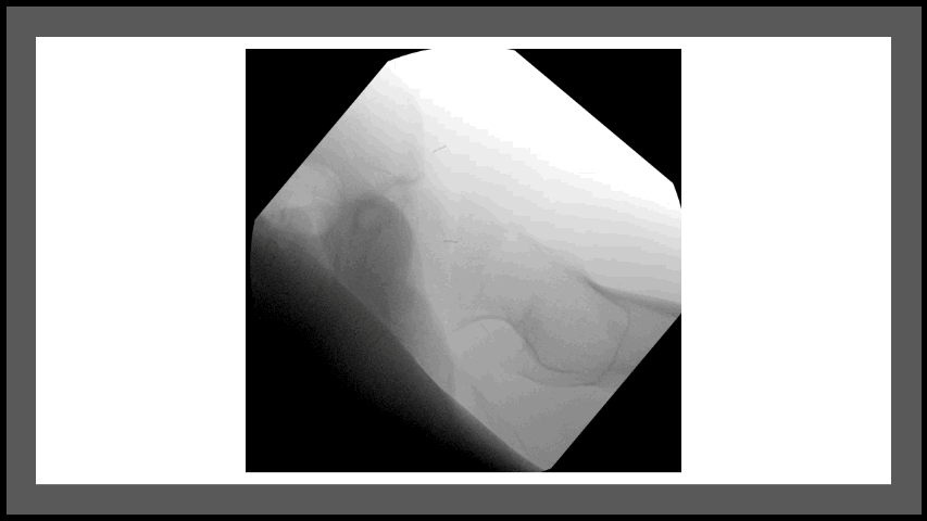 Fluoroscopy of femoral neck fixation