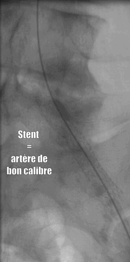 Schéma Stent