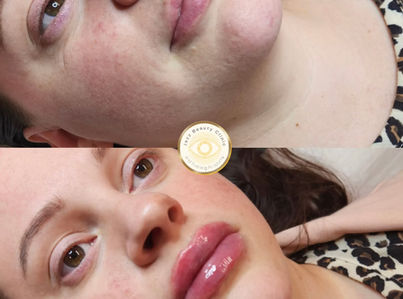 Before and after lip filler