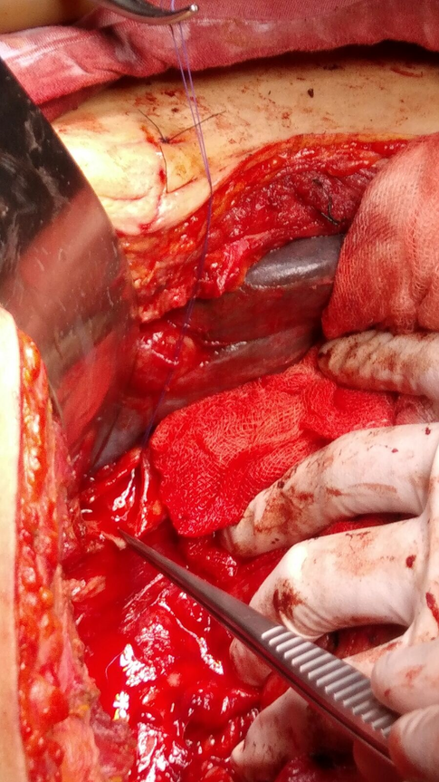 Seccion de Quiste, buena vascularidad por arteria hepatica, se observa confluencia de conductos hepaticos referido por sutura