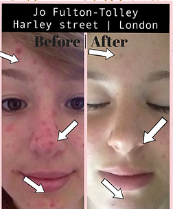 Before and afte LED facial results