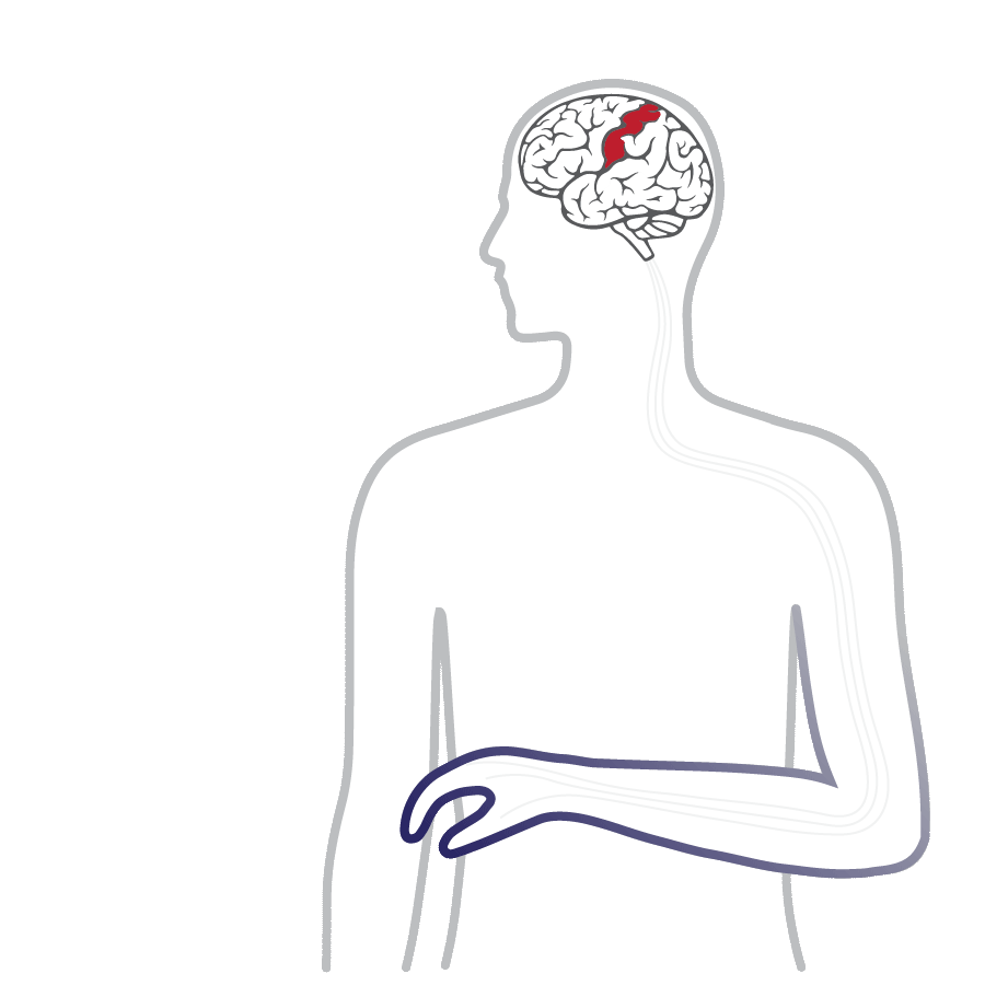 IpsiHand Rehab Device for Stroke Survivors Neurolutions