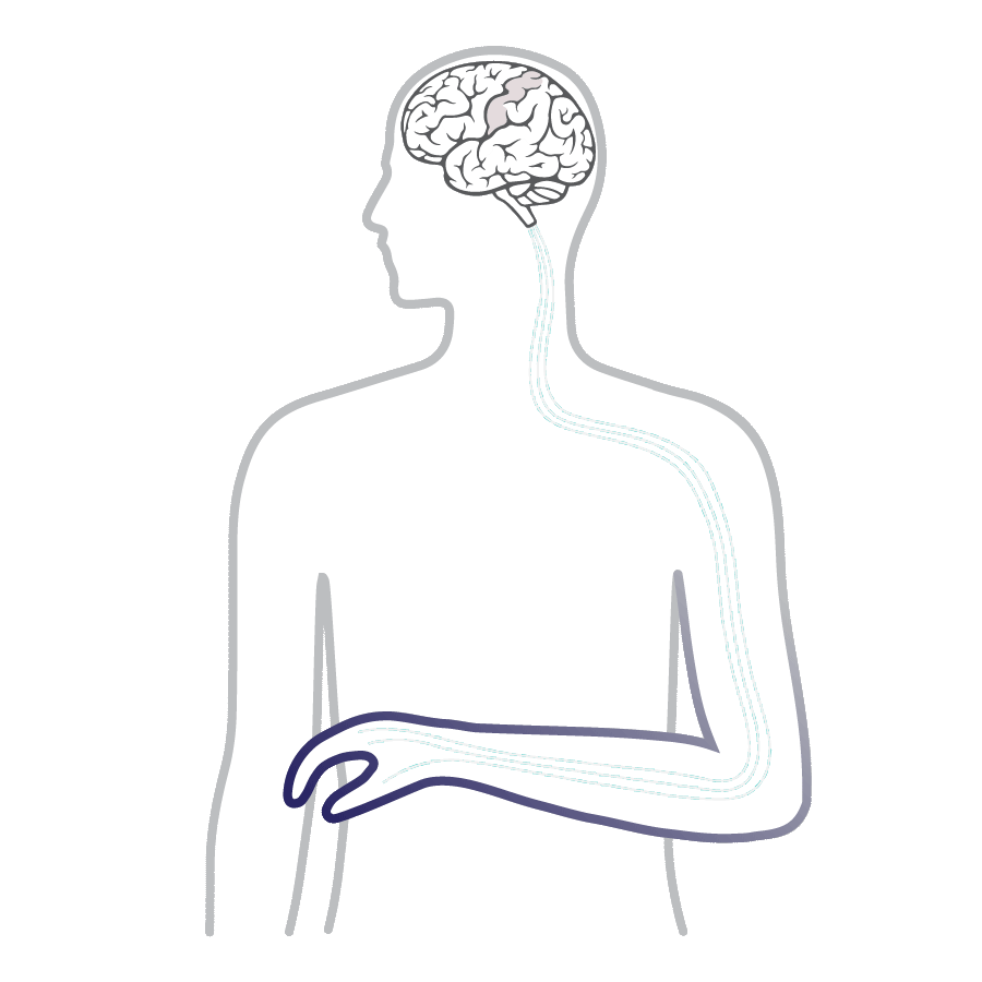 IpsiHand Rehab Device for Stroke Survivors Neurolutions