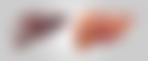 Healthy liver, smooth and brown, contrasted with a rough, bumpy cirrhotic liver.