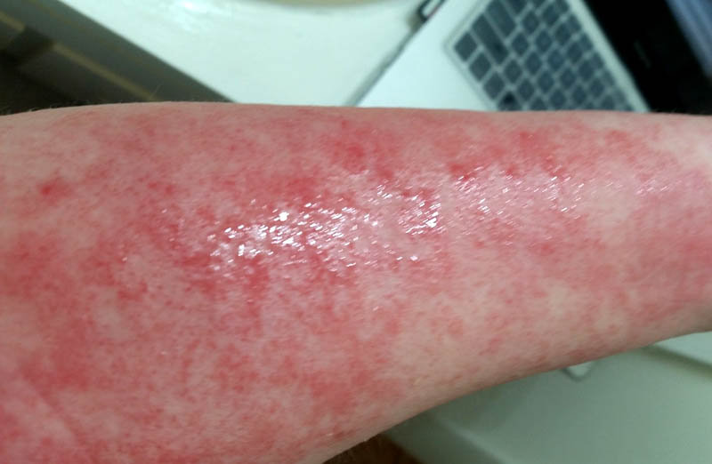 What is TSW Syndrome?