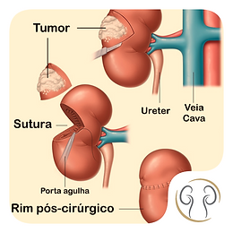 Nefrectomia Laparoscópica | Saulorecuero
