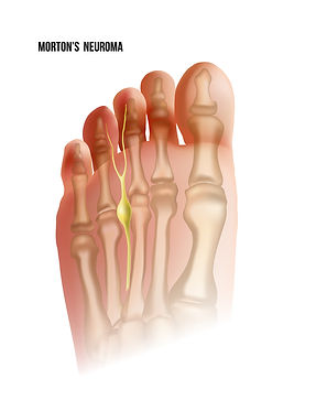 Morton's Neuroma diagram