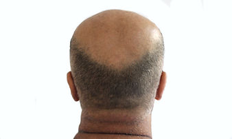 PatternBaldness.jpg