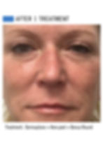 Chica Bloom Linder Health Chemical Peel Before and After