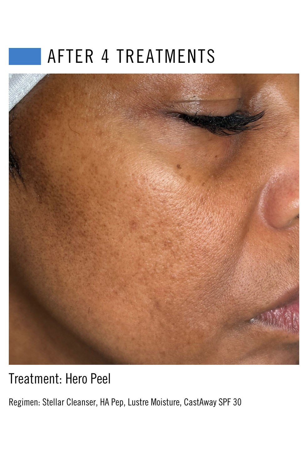 Chica Bloom Linder Health Chemical Peel Before and After