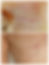 cicatrice_VP_2_séances_de_microneedling