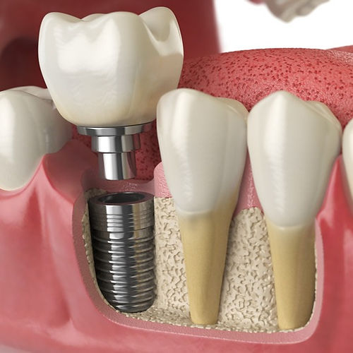 implantology_edited.jpg