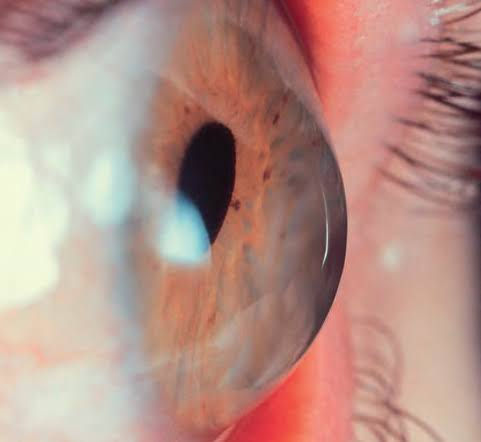 keratoconusul la copii - astigmatism ce se modifica la fiecare consult