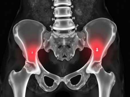 Understanding Acute Radiating Gluteal Pain in Endometriosis Linked to the Obturator Internus Muscle