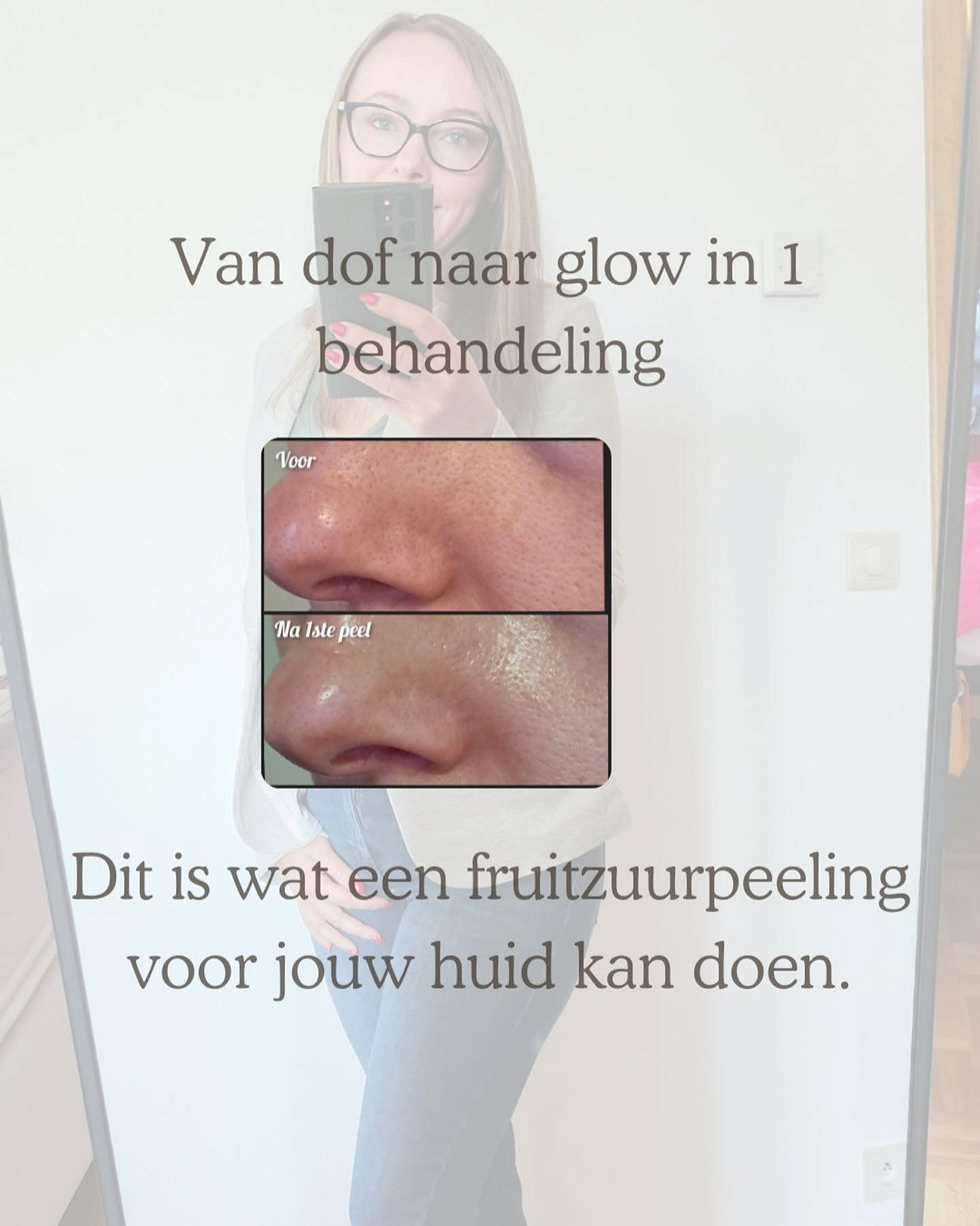 fruitzuurpeeling, chemischepeels, huidverbetering, rimpels, fijne lijntjes, pigmentatie, hyperpigmentatie, acne,