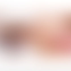 A Beginners Guide to Dermal Fillers.