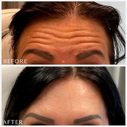 forehead anti-wrinkle injections