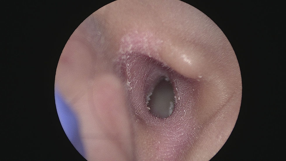 Endoscopic view of the external ear canal showing dry, flaky skin and scaling consistent with ear canal eczema.