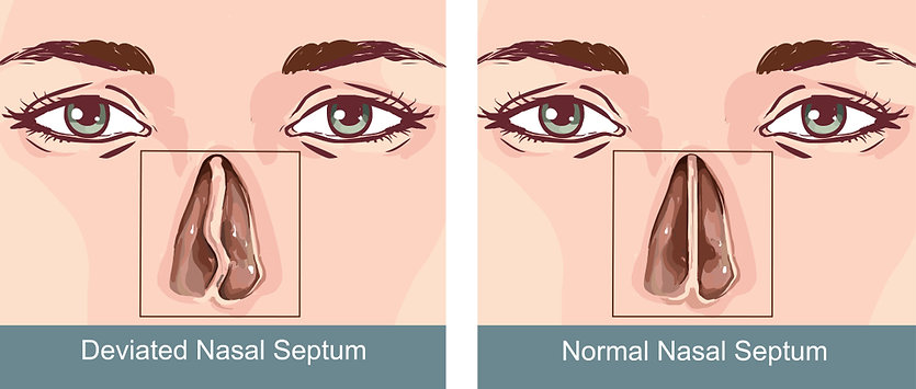 illustration of deviated nasal septum causes sinusitis