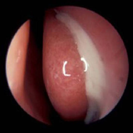 Endoscopic view of left nose showing acute sinusitis condition.