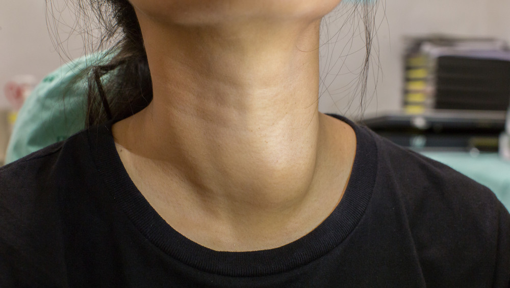 Thyroidectomy (Thyroid removal surgery) Dr Cheong ENT Johor