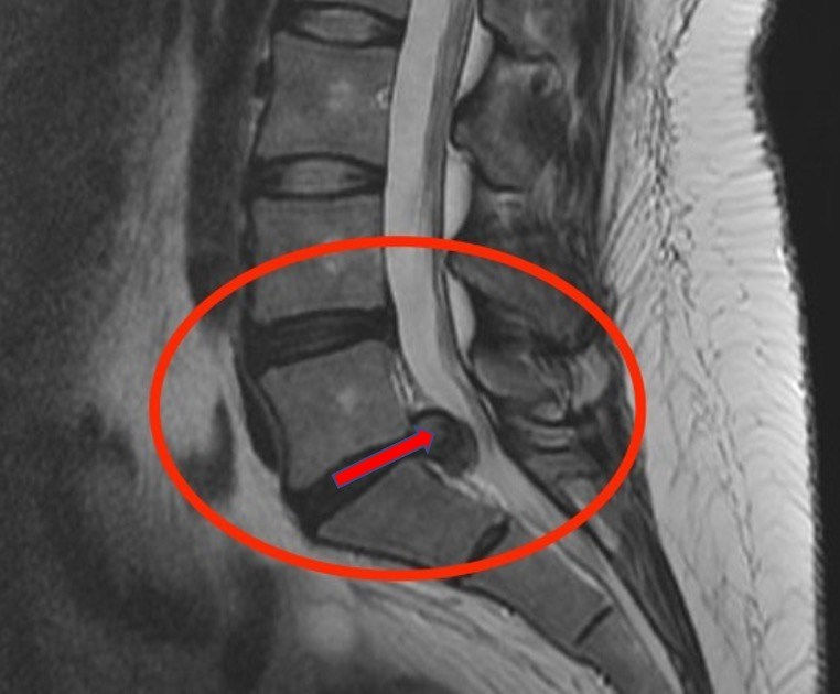 Coluna, Hernia de disco, dor nas costas, ciatico, especialista em coluna