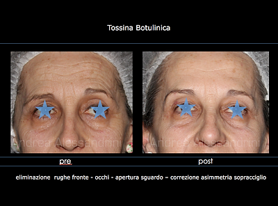 Botulino, Tossina Botulinica, Botox