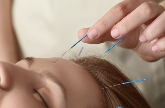 Acupuncture and Stress Relief: What Does the Evidence Suggest?