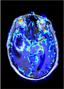 Tumro perfusión.png