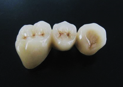 K-11014 Pure Titanium Porcelain-Fused-to-Metal (PFM) Crown