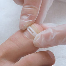 Nail Bracing for Ingrown Toenails