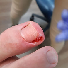 Nail Bracing for Ingrown Toenails