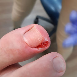 Nail Bracing for Ingrown Toenails
