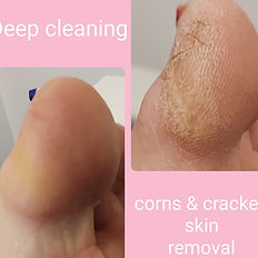 callus removal
