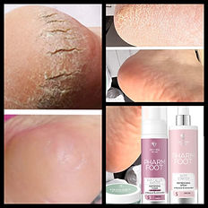 Cracked heel &hard skin feet removal