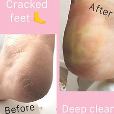 cracked heel grantham