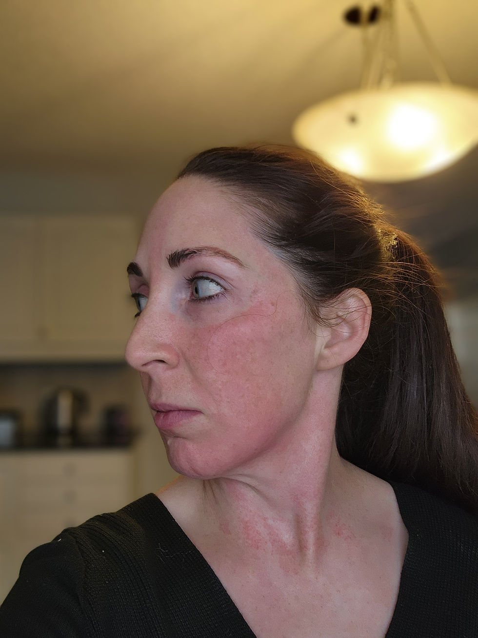 Face 2 hours post BBL+Moxi treatment