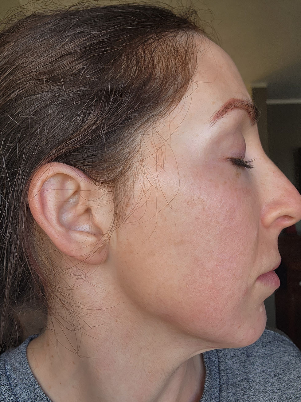 Face 6 days post BBL+Moxi laser facial treatment